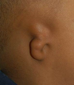 什么是先天性耳畸形Ⅲ度